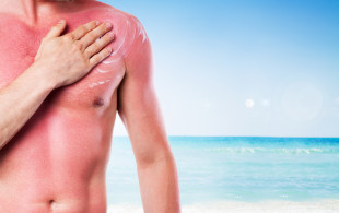 3 solutions naturelles pour apaiser les coups de soleil