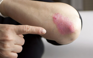 Bientôt un nouveau traitement pour le psoriasis