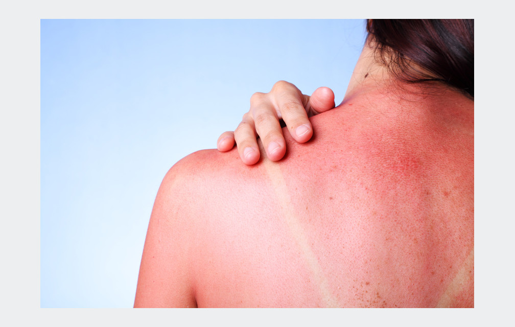 3 solutions naturelles pour apaiser les (futurs) coups de soleil