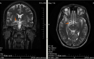 Pourquoi le cerveau pourrait jouer un rôle dans le développement des tumeurs